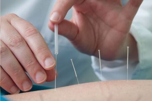 A acupuntura é un método para tratar a dor na rexión lumbar causada pola osteocondrose