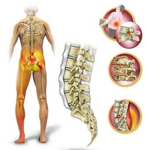Osteocondrose da columna lumbar, causando dor lumbar