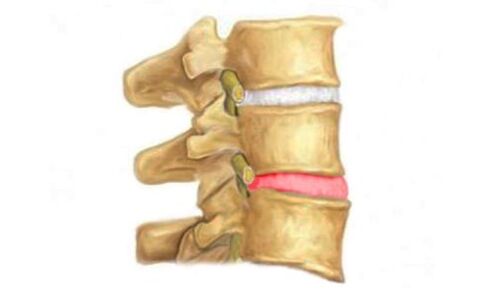 A protuberancia do disco intervertebral da columna vertebral - un sinal de osteocondrose