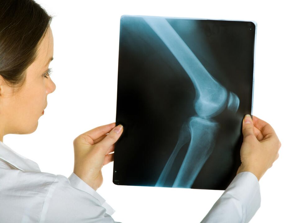 A radiografía da articulación do xeonllo revelará a presenza de artrose deformante