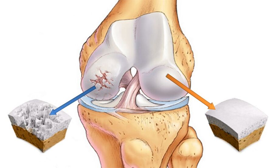 Articulación do xeonllo sa (dereita) e afectada por artrose (esquerda)